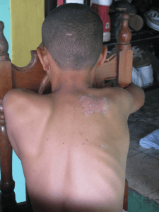 14 year old Abel shows rashes that have recurred for years. Abel’s blood, based on the just released 2007 government studies, contains over twice the levels of blood-lead content for children recommended as safe by the Centre for Disease Control and Prevention (CDC). From El Pedernal, a village near the Goldcorp mine, Abel started experiencing health problems as early as 2003 when he began losing chunks of hair.